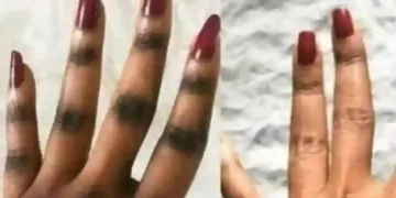 Somali women gamble health for pale skin