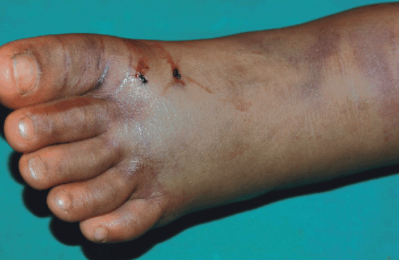 Lack of transport leads to death of five-year-old girl bitten by a venomous snake