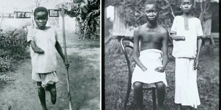 Historical photographs of Congolese children who survived severe mutilation during colonial-era atrocities in the Congo Free State